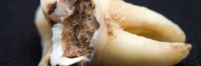 Revolutionary-product-could-be-the-end-of-tooth-decay