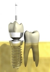 dental implants Port Washington