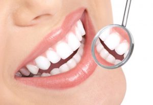 porcelain veneers Roslyn