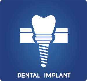 Dental Implant FAQ