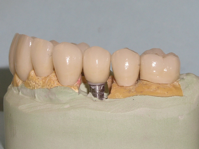 tooth model