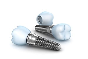 Dental Implant