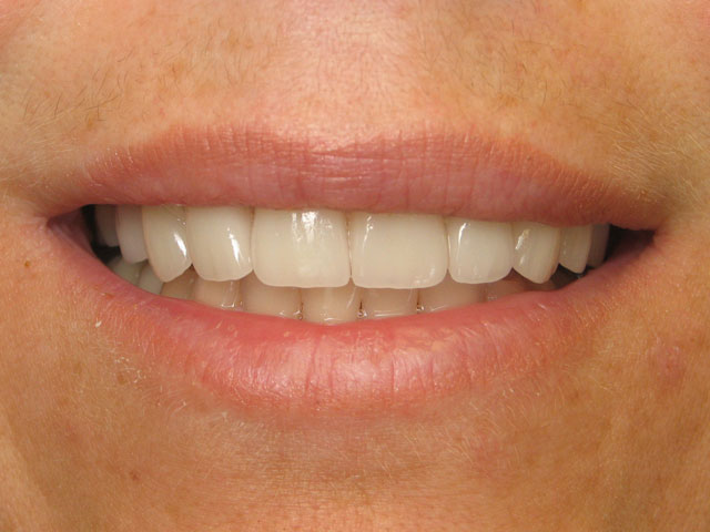 North Shore Dental, dental crowns