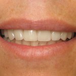 North Shore Dental, dental crowns