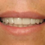 North Shore Dental, dental crowns