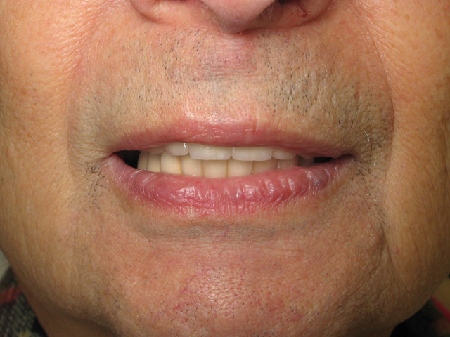 North Shore Dental, dental implants
