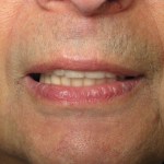 North Shore Dental, dental implants