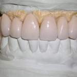 North Shore Dental, teeth mold