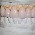 North Shore Dental, teeth mold