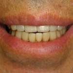 patient's smile, after treatment