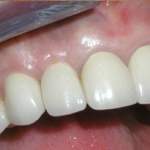 North Shore Dental, smile after treatment