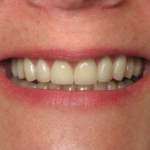 Roslyn, NY, smile after treatment