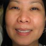 Roslyn, NY, smile post-treatment