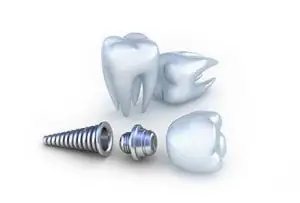 Dental Implant breakdown graphic
