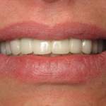 patient gets new smile, Northshore Dental