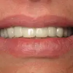patient gets new smile, Northshore Dental