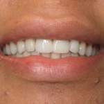 patient with new smile, Roslyn, NY