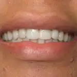 patient with new smile, Roslyn, NY