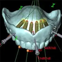 Image of dental implants