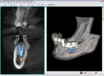 Image of dental implants on a screen