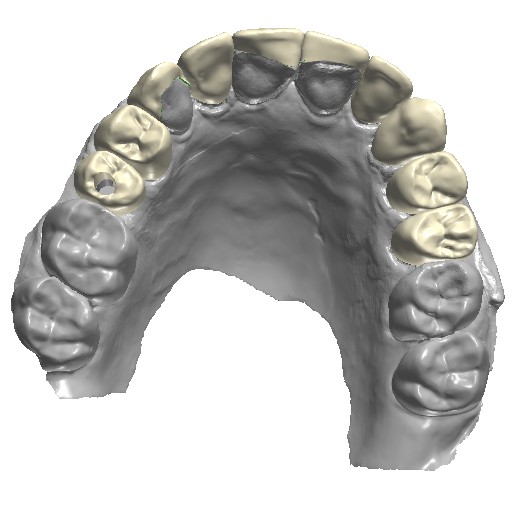 veneers