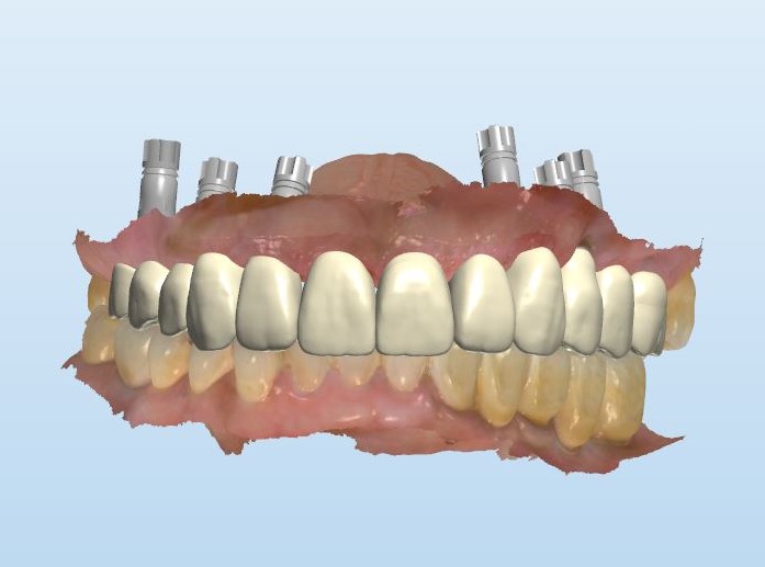 all-ceramic restorations