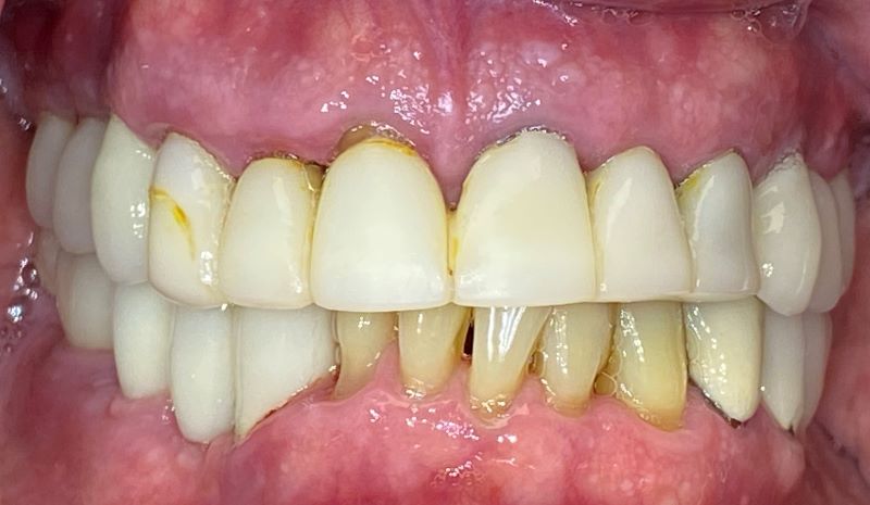 Case 40, Before Dental Implants