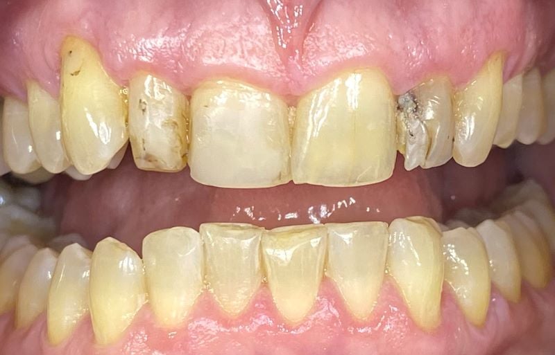 4 front teeth staining and crowding