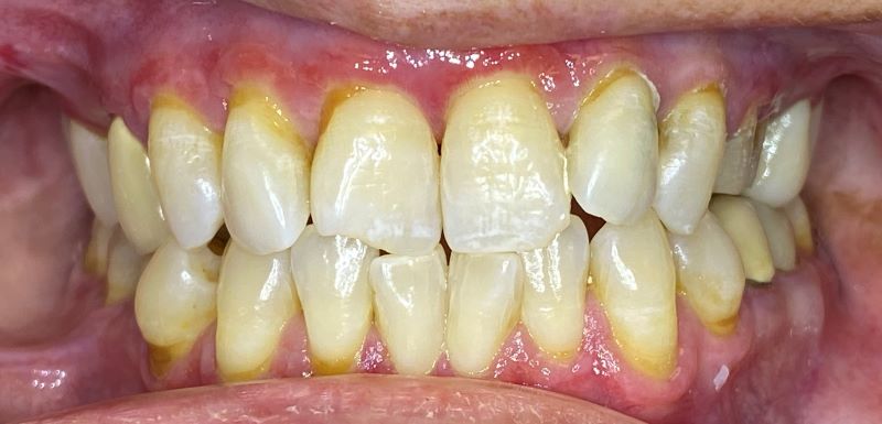 dental implants