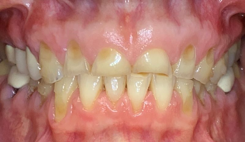 periodontal surgery