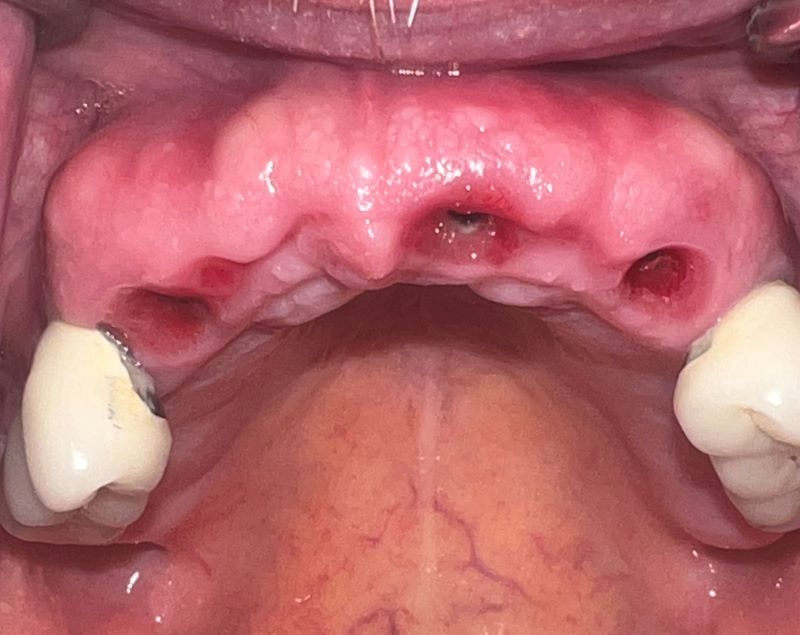 3 dental implants