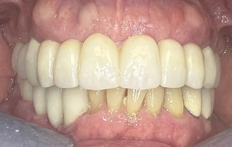 a dental implant-supported zirconia bridge.