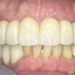 a dental implant-supported zirconia bridge.