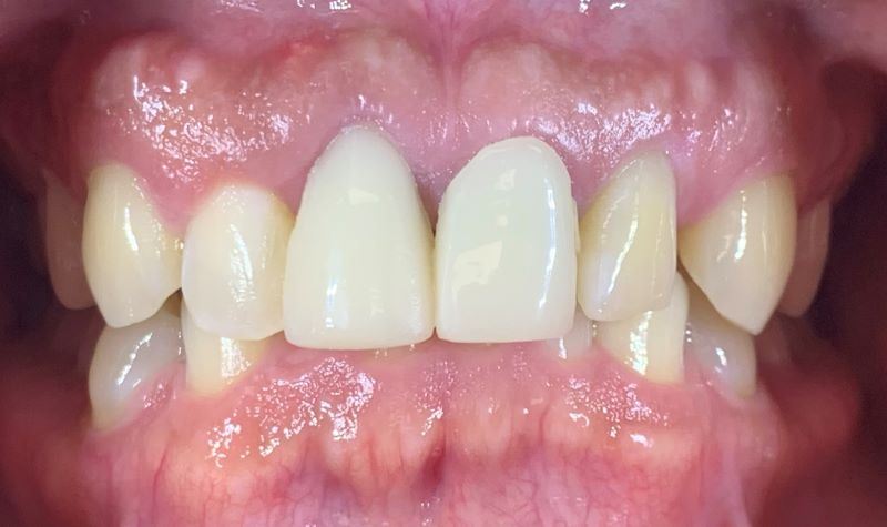 old crowns on two front teeth