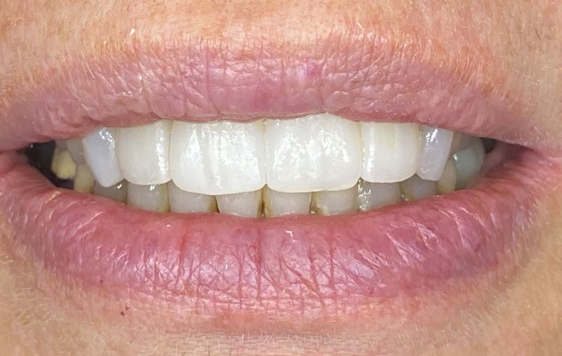 Case 39, After Dental Implants and Crowns