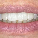 Case 39, After Dental Implants and Crowns