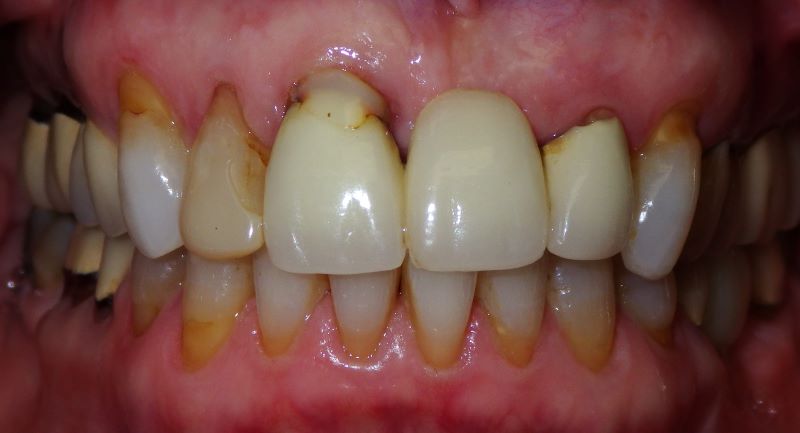 Case 39, Before Dental Implants and Crowns