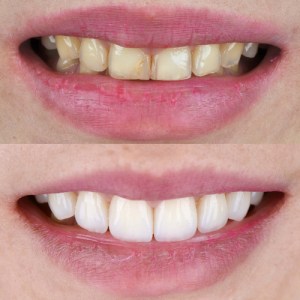 before and after smile makeover